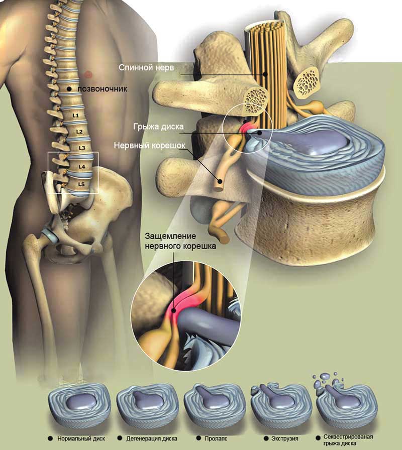 Мифы о межпозвонковых грыжах